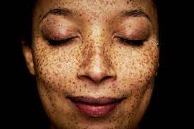 How Dermatologists Can Help Manage Chronic Skin Conditions