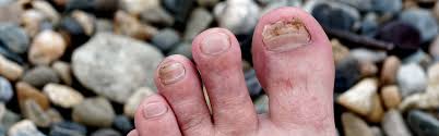 Signs You Might Have an Ingrown Toenail and What To Do About It