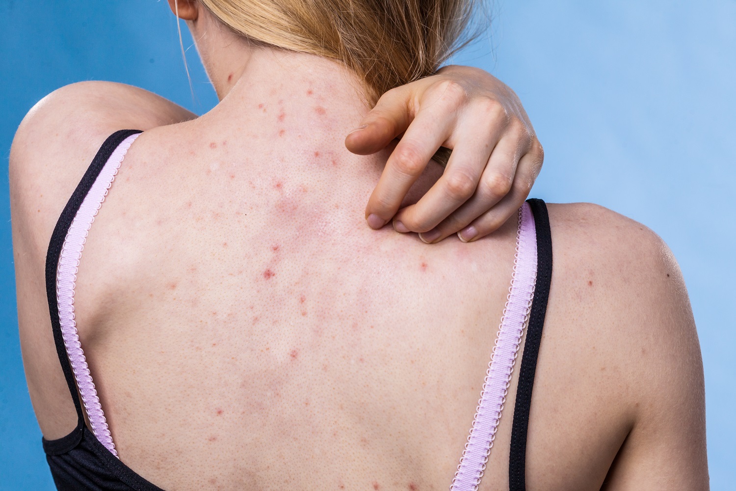Understanding the Different Types of Acne and Their Treatments