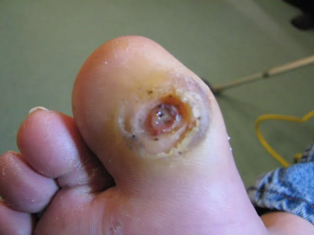 Why Proper Wound Care Is Essential for Healing