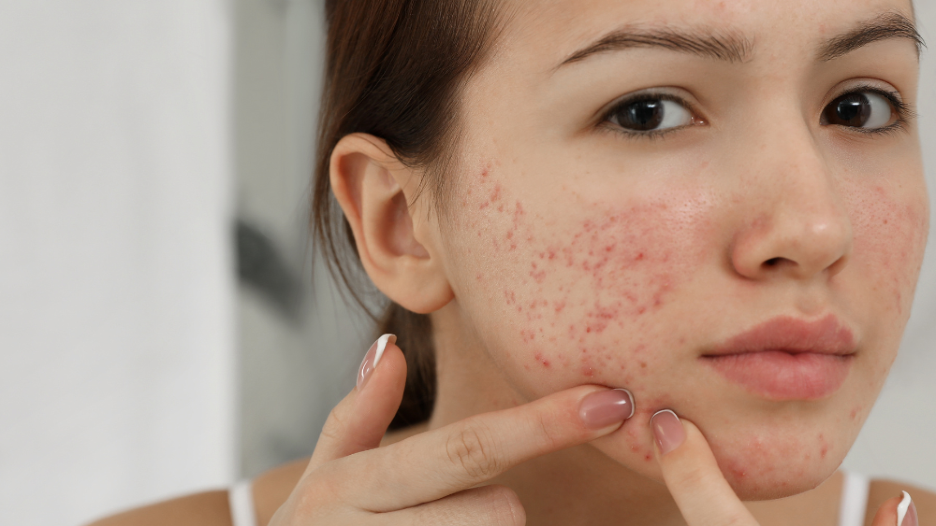 Affordable Acne Treatment Clinic Near Me – A Complete Guide to Clearer Skin