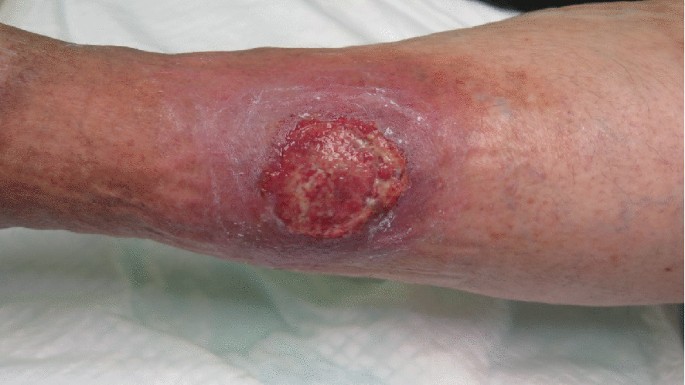 Best Practices for Post-Surgical Wound Care Best Practices for Post-Surgical Wound Care