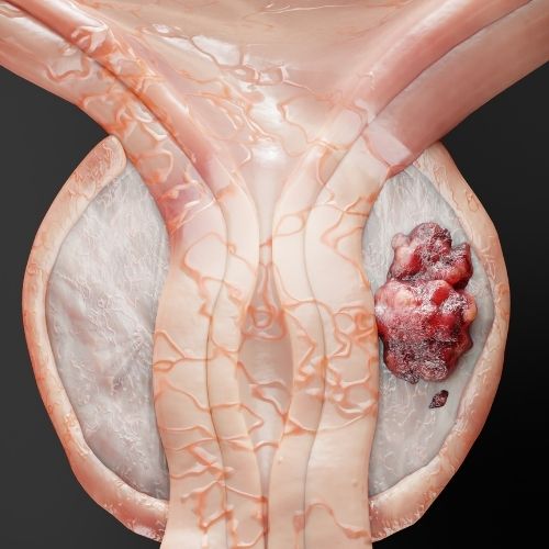 Exploring Treatment Options for Prostate Cancer: What Patients Should Know