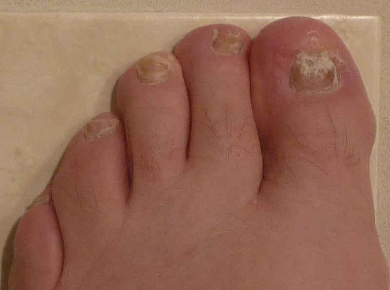 Exploring the Connection Between Fungal Nails and Diabetes