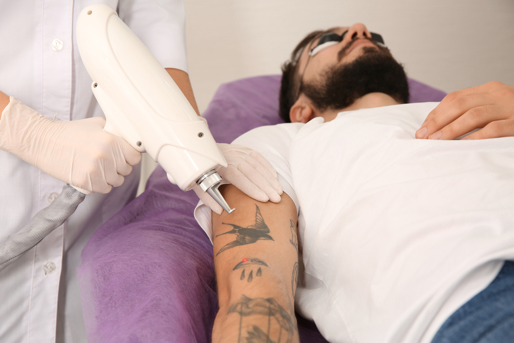 How to Prepare for Tattoo Removal