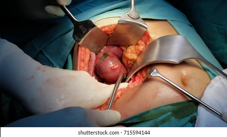 Long-Term Effects of Gallbladder Surgery