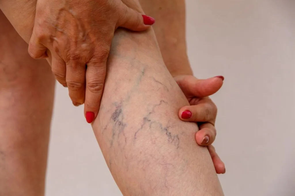Spider Veins: How Hormones Play a Role in Their Development