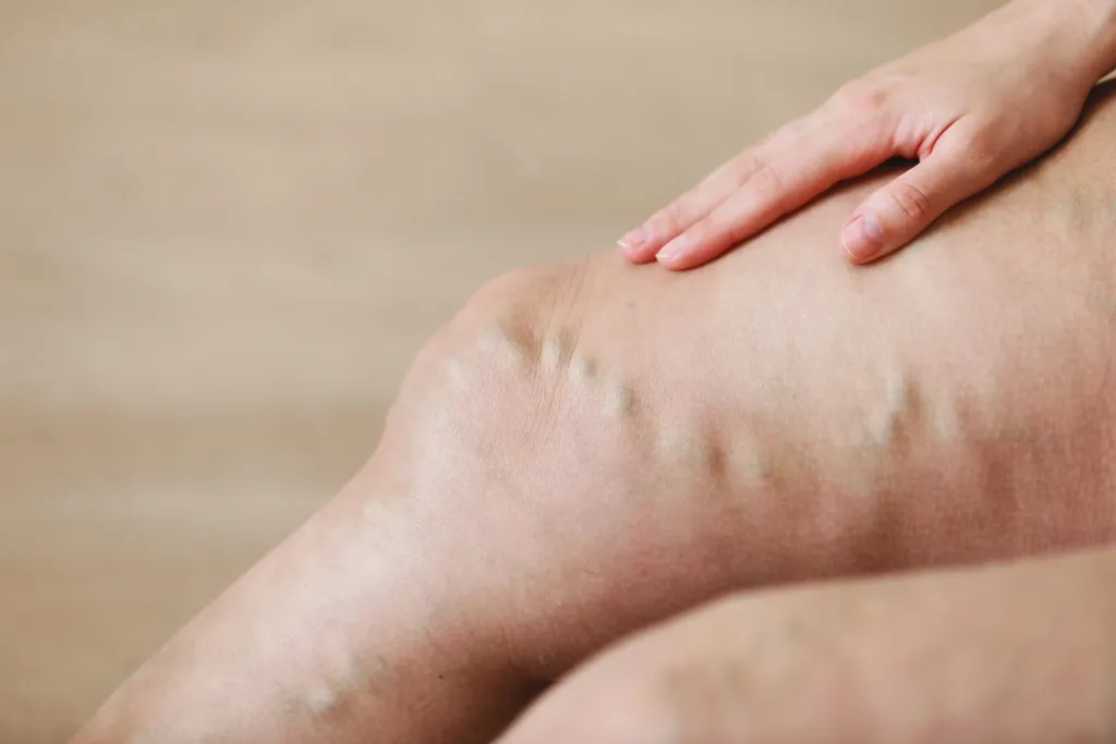 What You Should Know About Varicose Veins and Treatment Options What You Should Know About Varicose Veins and Treatment Options