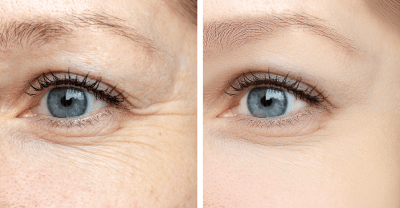 Botox Red The Benefits of Botox for Fine Lines and Wrinkles - redandwhitemages.com