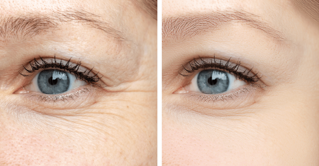 The Benefits of Botox for Fine Lines and Wrinkles