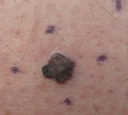 Understanding the Different Stages of Melanoma