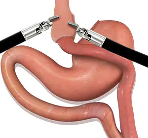 Comparing Gastric Sleeve Surgery and Gastric Bypass