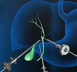 Coping With Changes in Digestion After Gallbladder Removal