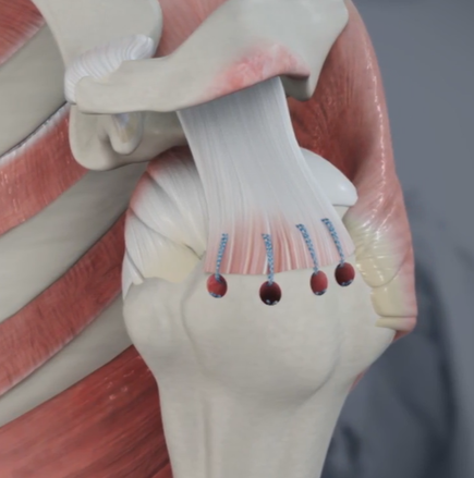 Diagnosis and Management of Rotator Cuff Tears