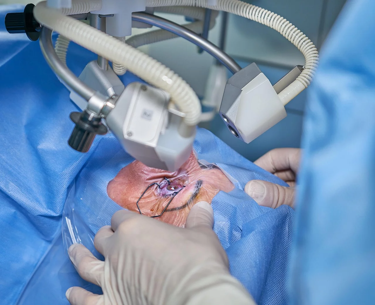 Exploring the Benefits of Lasik Surgery Exploring the Benefits of Lasik Surgery