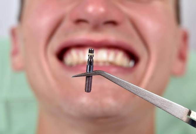 From Tooth Removal to a New Smile How Same-Day Dental Implants Work From Tooth Removal to a New Smile: How Same-Day Dental Implants Work