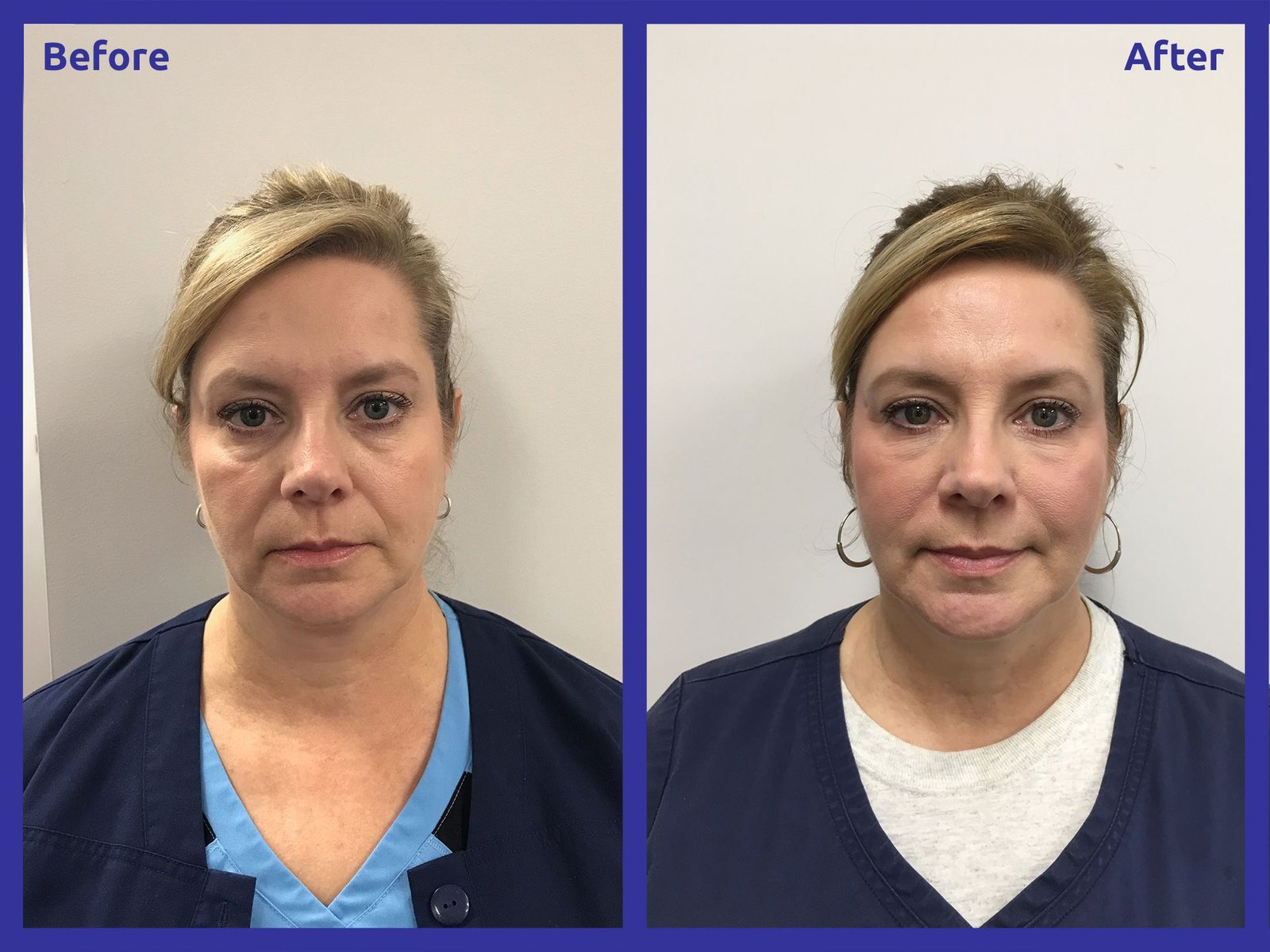 How Dermal Fillers Can Transform Your Look How Dermal Fillers Can Transform Your Look