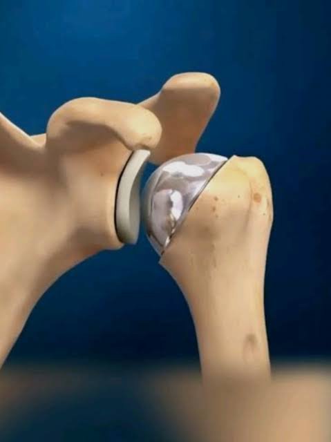How Robotic-Assisted Joint Replacement is Changing Orthopedic Surgery How Robotic-Assisted Joint Replacement is Changing Orthopedic Surgery