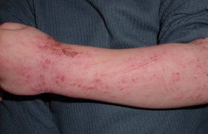 Identifying and Managing Food Allergies in Children