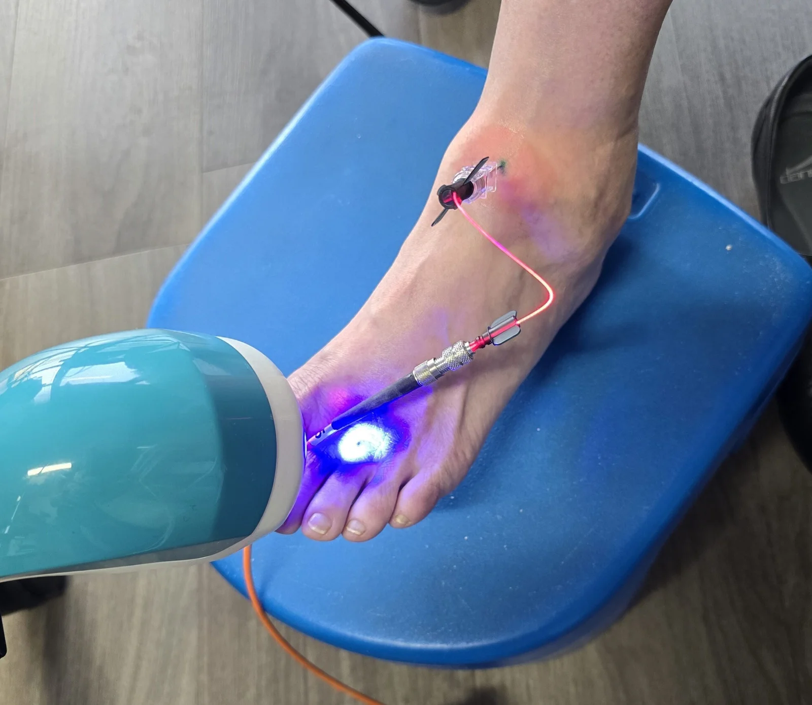 Innovative Treatments for Plantar Fasciitis Innovative Treatments for Plantar Fasciitis