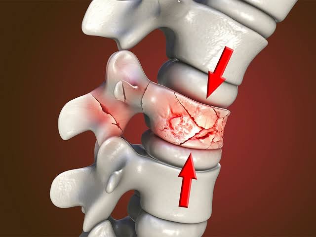 Minimally Invasive Options for Spinal Fractures