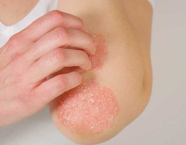 Navigating the Effects of Eczema