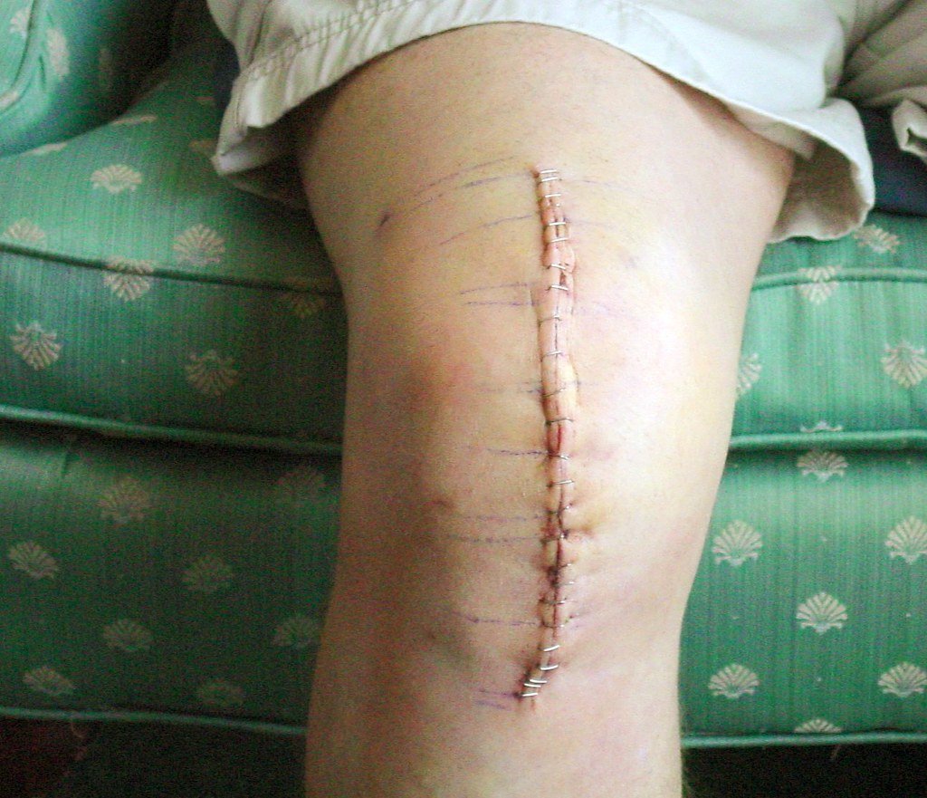 Post-Operative Care for Knee Replacement Patients Post-Operative Care for Knee Replacement Patients