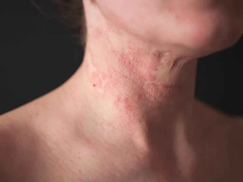The Connection Between Eczema and Allergies