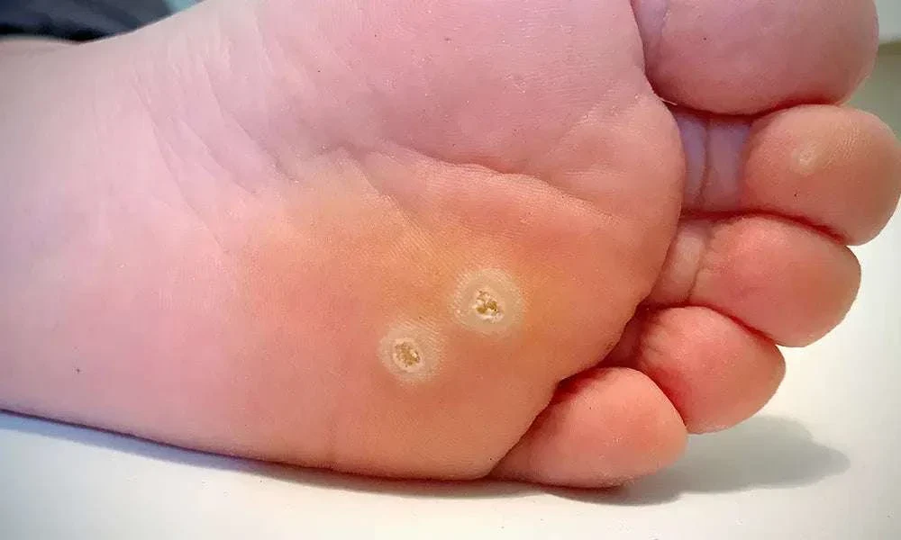 The Role of a Plantar Wart Specialist in Managing Foot Health