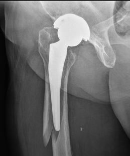 Understanding Recovery After Hip Replacement Surgery Understanding Recovery After Hip Replacement Surgery