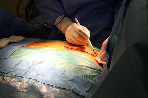 Understanding the Different Types of Hernia Repair Techniques