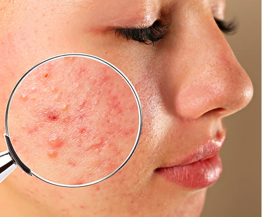 Wellness Center Treatments for Acne
