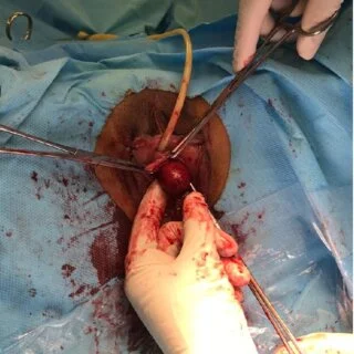 What Are the Treatment Options for Gallbladder Disease What Are the Treatment Options for Gallbladder Disease?