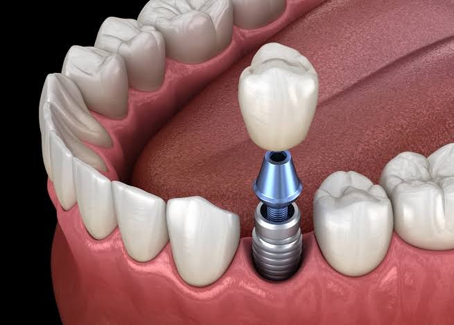 What You Need to Know About Dental Implant Maintenance What You Need to Know About Dental Implant Maintenance