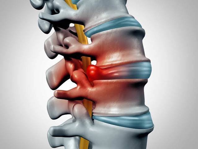 What You Should Know About Living with a Herniated Disc
