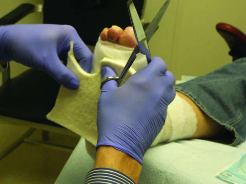 When To Get Help With Diabetic Wound Care When To Get Help With Diabetic Wound Care