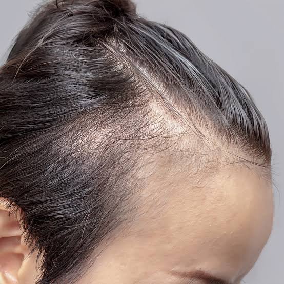 When To See a Doctor About Hair Loss