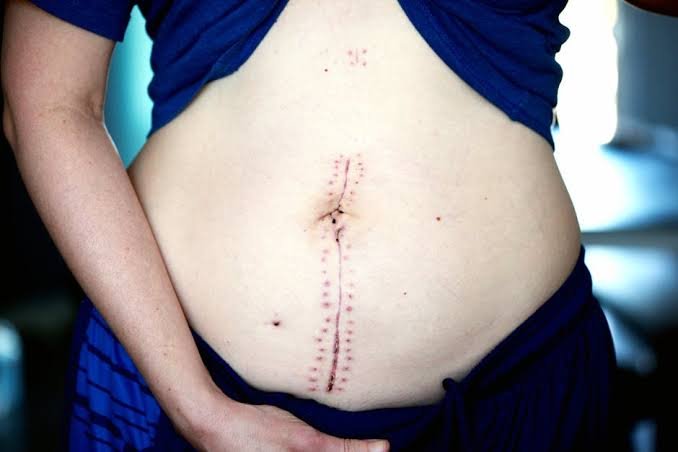 Enhancing Your Natural Beauty Through Abdominal Wall Reconstruction Enhancing Your Natural Beauty Through Abdominal Wall Reconstruction