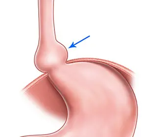 Recognizing Hiatal Hernias Recognizing Hiatal Hernias