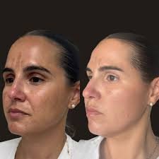 The Advantages of Halo Laser Resurfacing for Treating Acne Scars and Aging Skin The Advantages of Halo Laser Resurfacing for Treating Acne Scars and Aging Skin