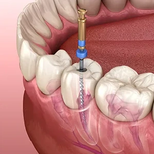What To Expect During a Root Canal Procedure What To Expect During a Root Canal Procedure