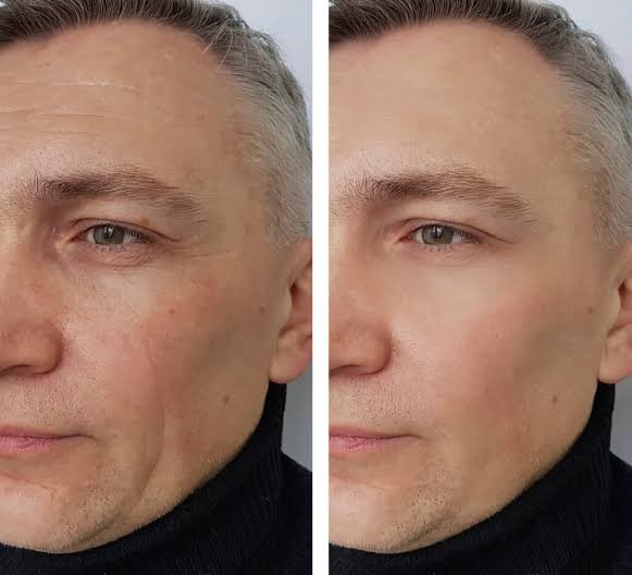 What do Botox Procedures Consist Of?