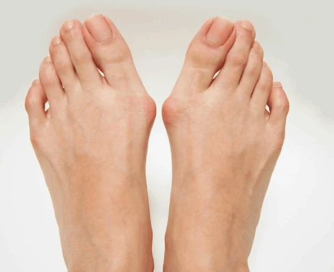 Why You Should Consult a Foot Specialist for Bunions