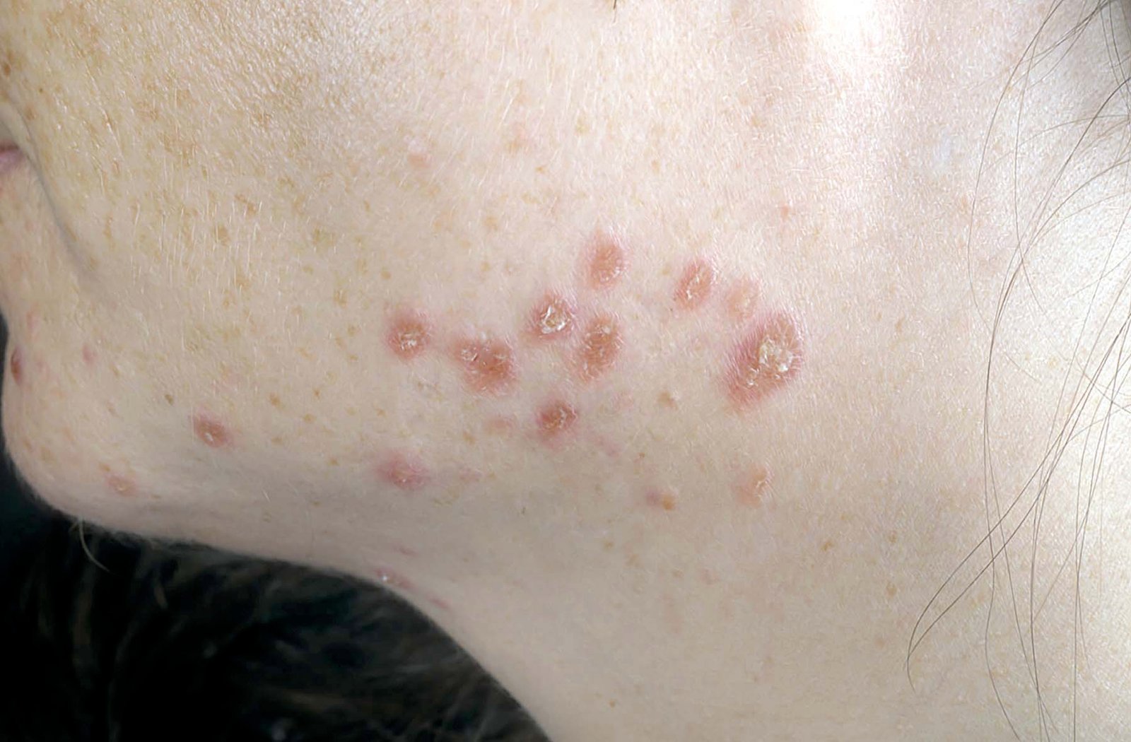 Common Pediatric Dermatology Concerns Common Pediatric Dermatology Concerns