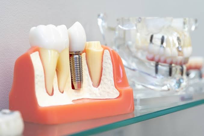 Dental Implants: A Complete Guide to Replacing Missing Teeth