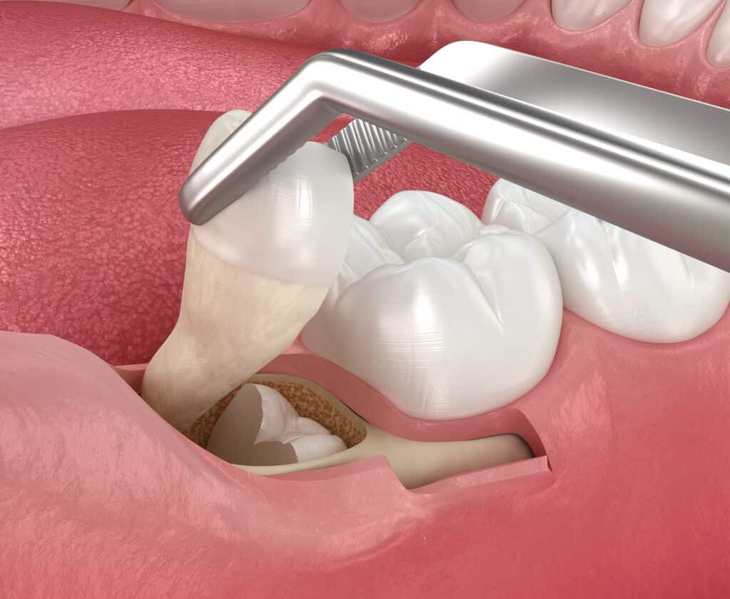 Signs That Your Wisdom Teeth May Need Removal