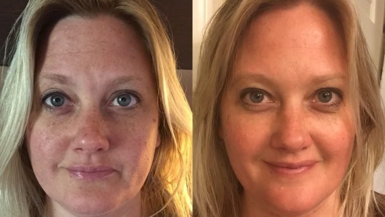Understanding the Different Types of Chemical Peels and Their Uses