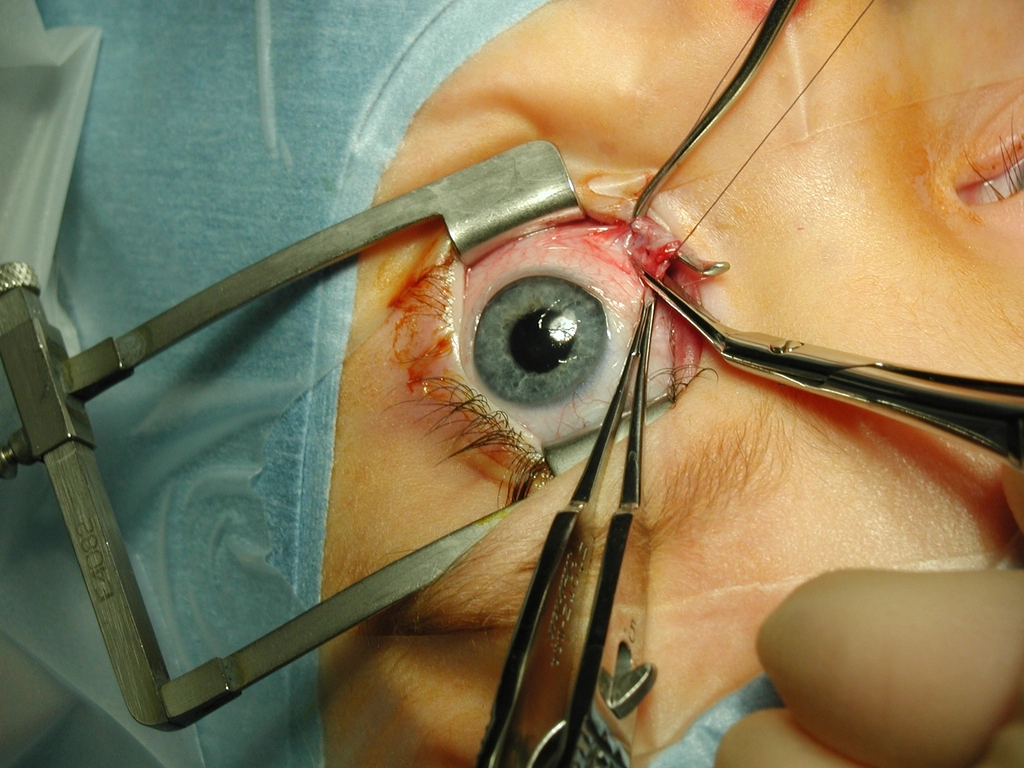 Premium Lens Options: What to Know Before Cataract Surgery