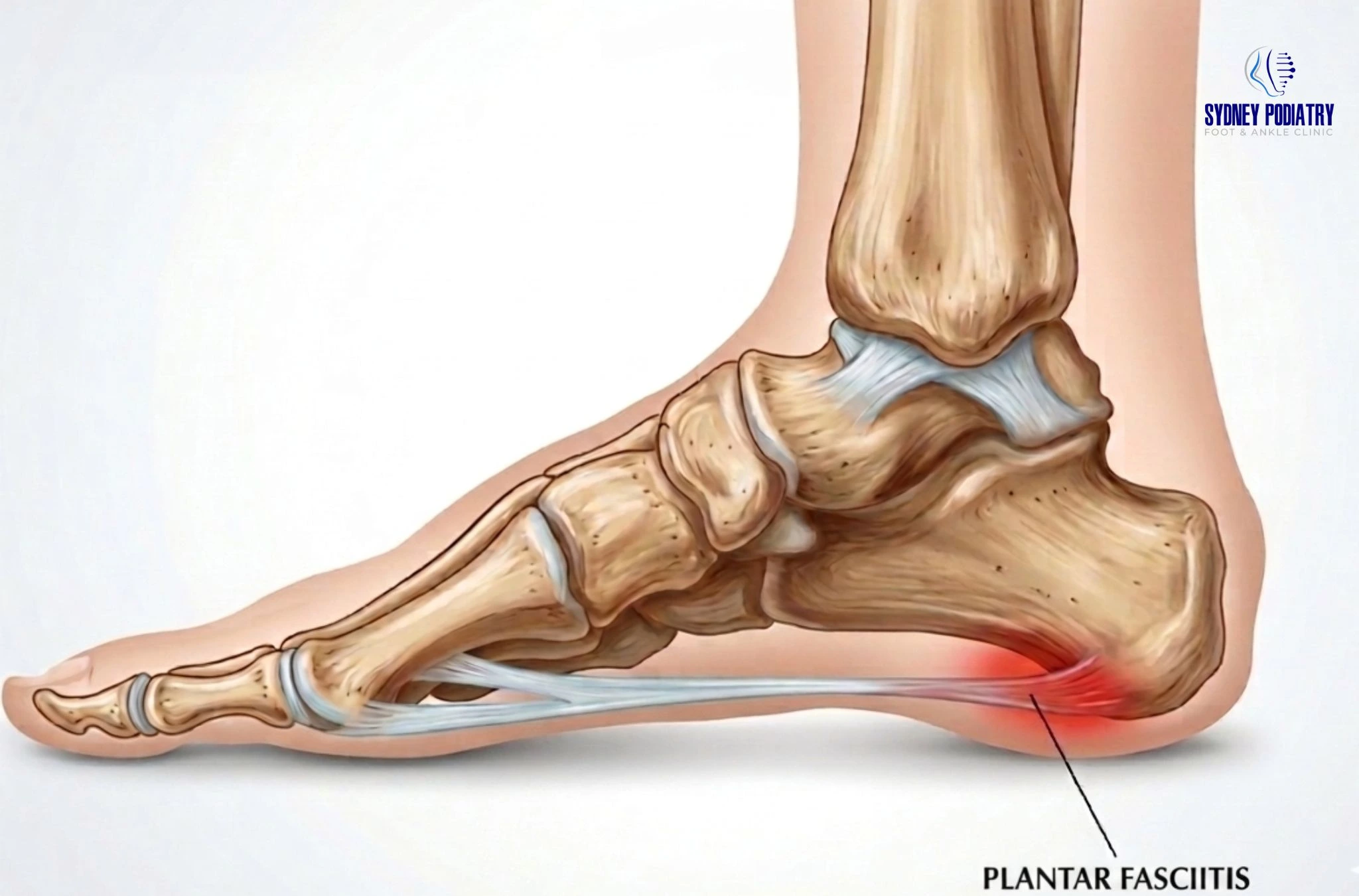 Understanding the Causes and Symptoms of Plantar Fasciitis